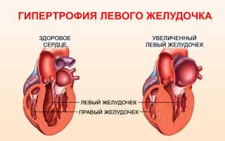 Умеренная дилатация левого предсердия что это такое
