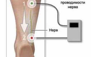 Поражение бокового подколенного нерва симптомы лечение