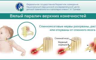 Клиника. 1. Верхний паралич плечевого сплетения (паралич Эрба-Дюшенна) — наиболее распространенный вид паралича