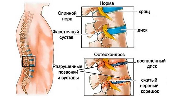 Наиболее часто к корешковому синдрому приводит остеохондроз