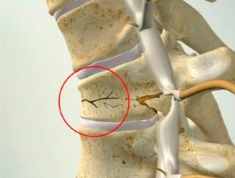 При искривлении позвоночника происходит деформация межпозвонковых дисков и хрящей