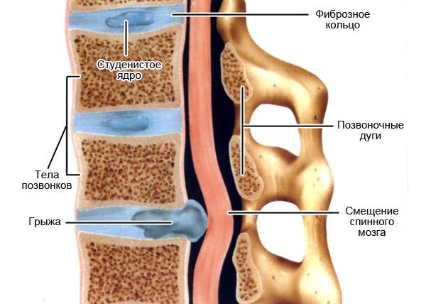 Ниже описаны причины возникновения грыжи межпозвонкового диска