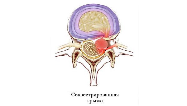 Операция требуется при секвестрации грыжи позвоночника