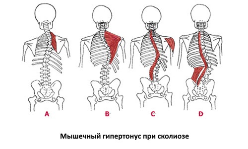 С особой осторожностью и только по назначению врача кинезио тейп используют при сколиозе