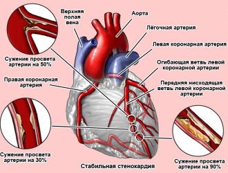 Запрещен прием Каффетина СК при стенокардии