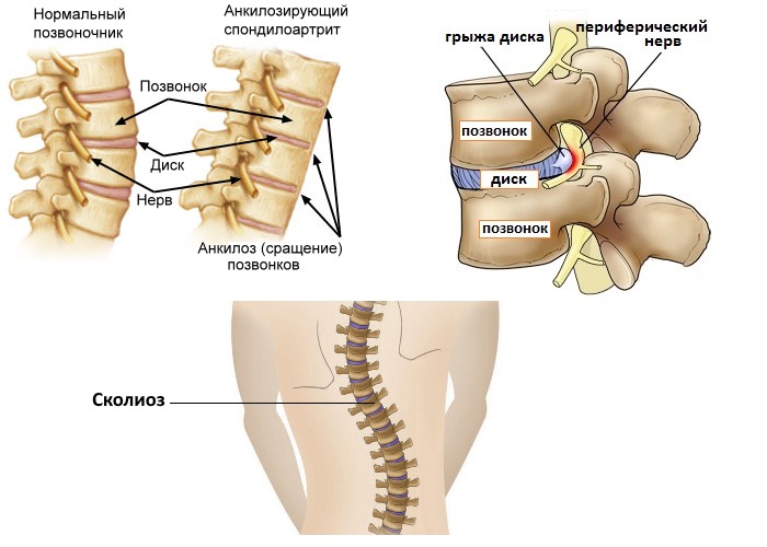 Чаще всего тракцию назначают при искривлении позвоночника и заболеваниях ведущих к компрессии нервных корешков