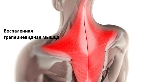 Наиболее часто при переохлаждении страдает трапециевидная мышца