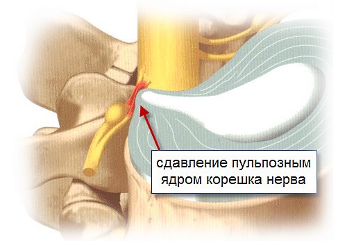 Запрещено делать массаж при острой корешковой боли