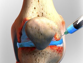 Вводят препарат Гиалган Фидия непосредственно в сам сустав