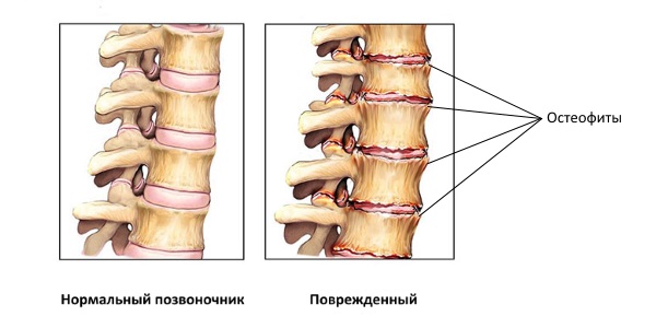 Отложение солей в позвоночнике способствует образованию костных выростов на позвонках