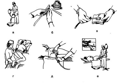 Правила проведения клизимрования