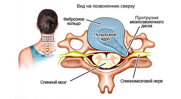 При дорзальной протрузии C5-C6 происходит выпячивание диска в сторону спинного мозга в шейном отделе