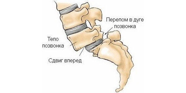 Смещение позвонков вызывает защемление нервных корешков