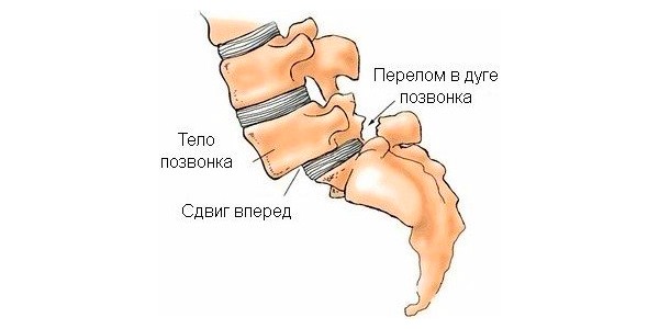 Чаще всего смещение L4 и L5 позвонка происходит из-за перелома дужки