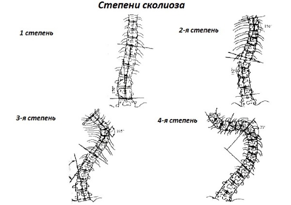 Обратите внимание на степени искривления позвоночника при сколиозе