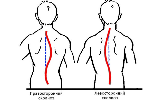 Обратите внимание на то, как именно выглядит левосторонний сколиоз