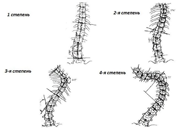 Детский сколиоз проходит 4 стадии осложнения