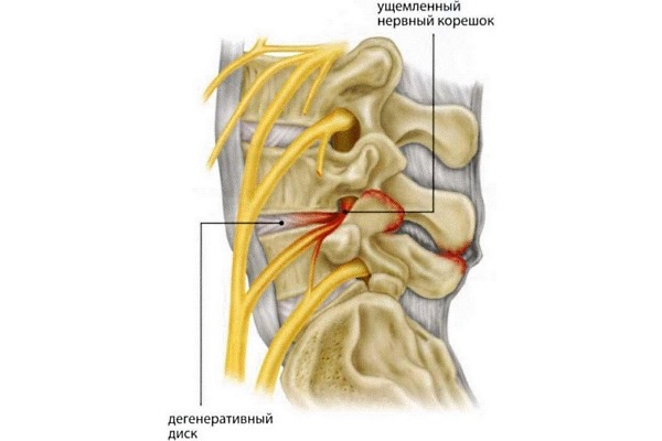 Радикулит является симптомом - ущемление нервного корешка в следствии дегенеративных изменений в позвоночнике