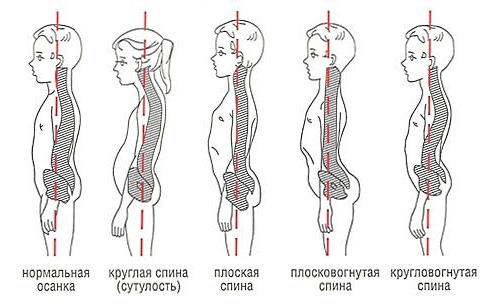 Для диагностики искривления спины у ребенка достаточно его поставить вертикально