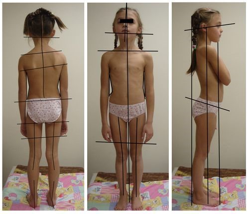 Сколиоз можно диагностировать по ассиметричному размещению тела