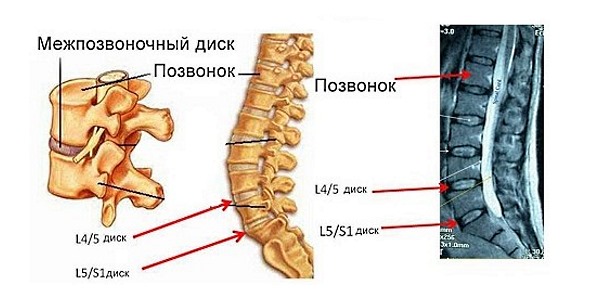 В основном в поясничном отделе позвоночника грыжа развивается в сегменте L4-L5 и L5-S1