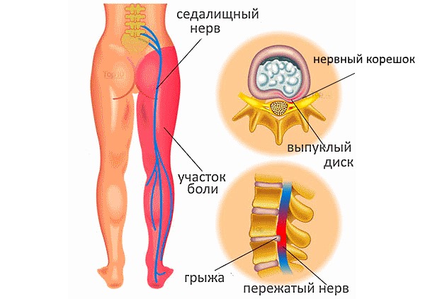 Все типы сильных болей в пояснице связаны с компрессией нервных окончаний позвоночника