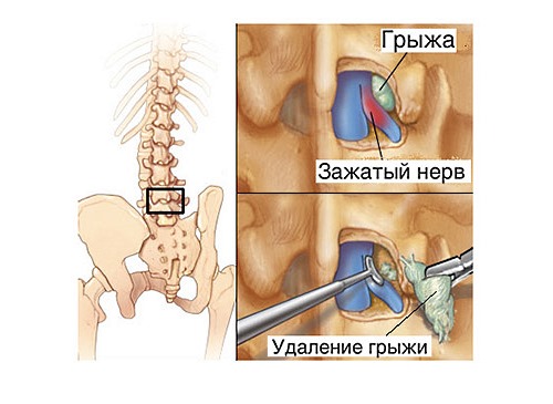 В качестве радикального метода возможно применение микродискэктомии