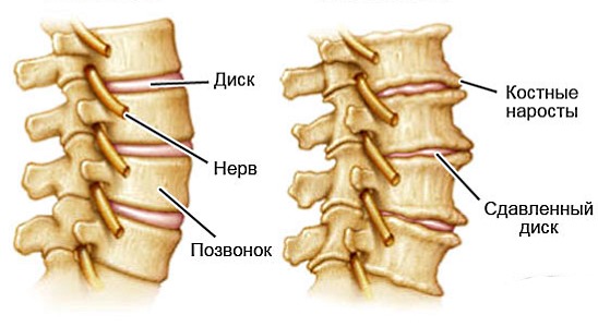 Остеохондроз и спондилез - часто встречаются в пояснично-крестцовой зоне