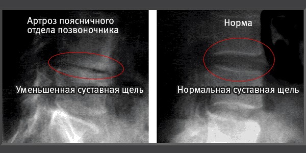 Диагностировать артроз позвоночника можно с помощью рентгена