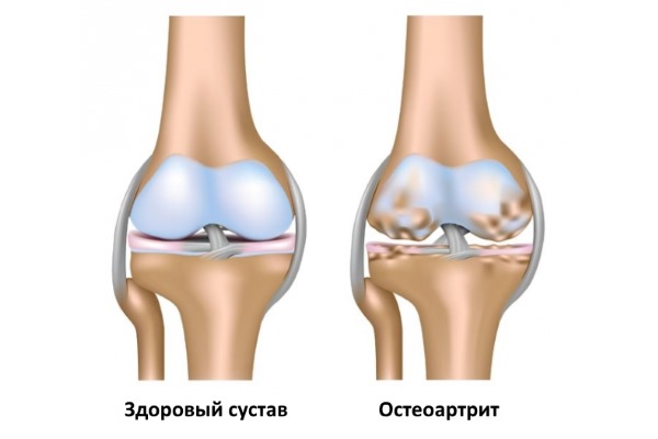 Остеоартрит сопровождается сильными болями в суставах из-за высокой нагрузки
