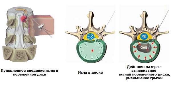 Лазерное удаление грыжи - современный метод, который позволяет выпаривать влагу из диска