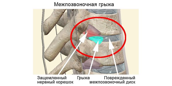 При выпадении ядра грыжа пережимает нервные корешки