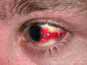 лопнул копиляр