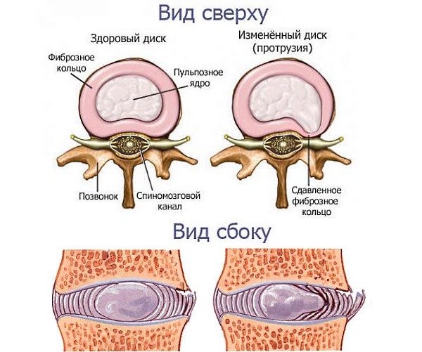 Применять конский жир от грыжи можно на первых стадиях болезни