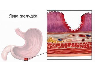 При язвенных поражениях Фламидез нельзя использовать