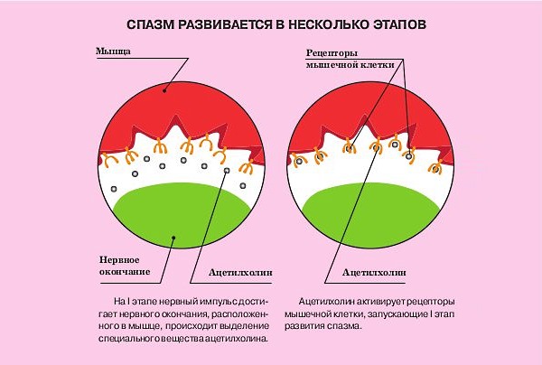 При мышечно-тоническом синдроме происходит спазм гладкой мышцы спины