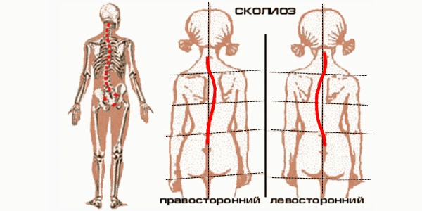 В детском возрасте сколиоз чаще поражает девочек, чем мальчиков