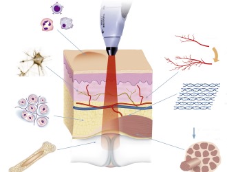 Особое значение в лечении грыжи позвоночника занимают физиопроцедуры