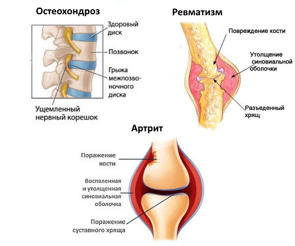 Средство Рецепт гор позволяет избавиться от большинства известных заболеваний хрящевой ткани