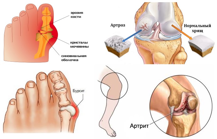 Суставерин применяют для лечения и профилактики заболеваний суставов