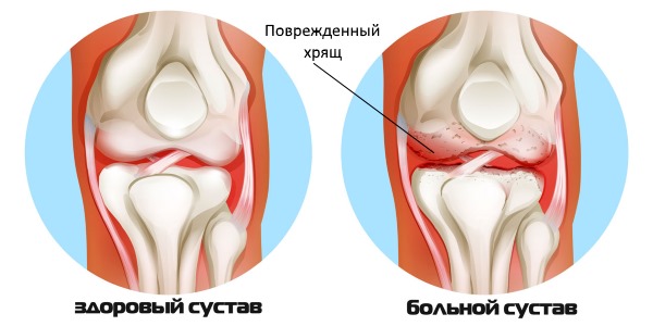 Ихтиол устраняет воспаление в суставе при артрите