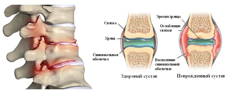 Как правило причинами болей в шее являются дегенеративные изменения в хрящах позвоночника