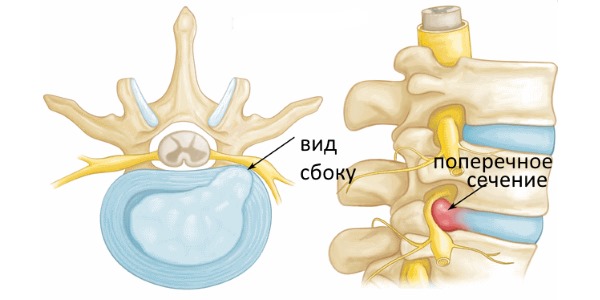 Назначают Нимесулид Тева при остеохондрозе и невралгических заболеваниях