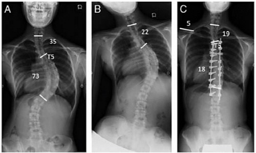 Операция по исправлению позвоночника производится в два этапа - выравнивание и фиксирование