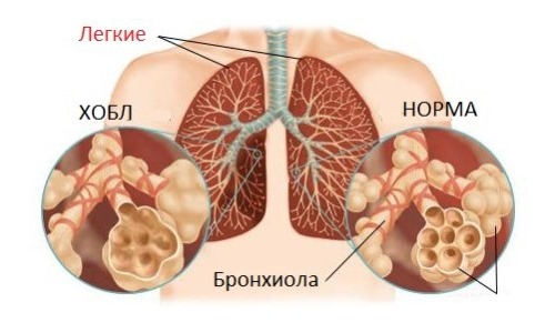 Люди, страдающие хроническими заболеваниями дыхательных путей, могут столкнуться с некоторыми осложнениями после использования Финалгеля