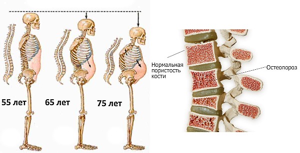 Женщины больше подвержены развитию остеопороза, чем мужчины