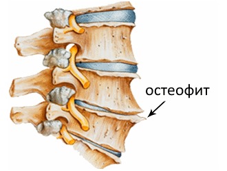 О дегенеративно-дистрофических изменениях свидетельствует разрастание остеофитов