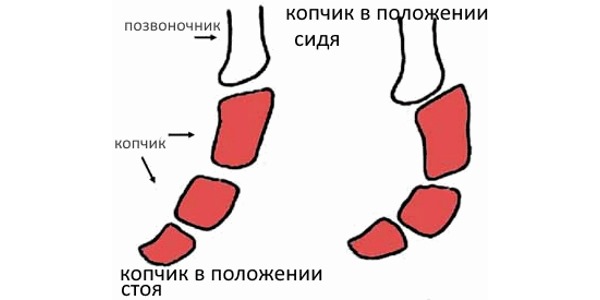Первичная кокцигодиния связана непосредственно с повреждением самого копчика