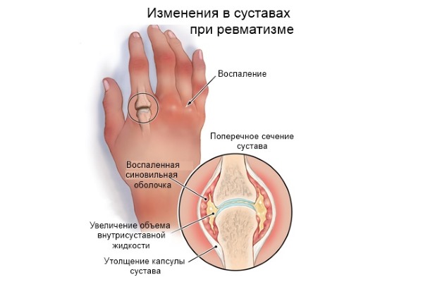 Принимать Мефенаминку можно при ревматических поражениях