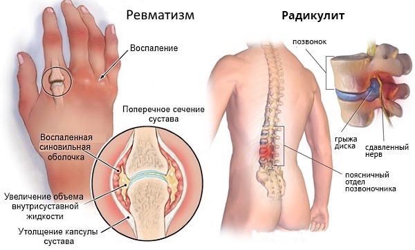 Дип Рилиф помогает избавиться от болей в позвоночнике и суставах
